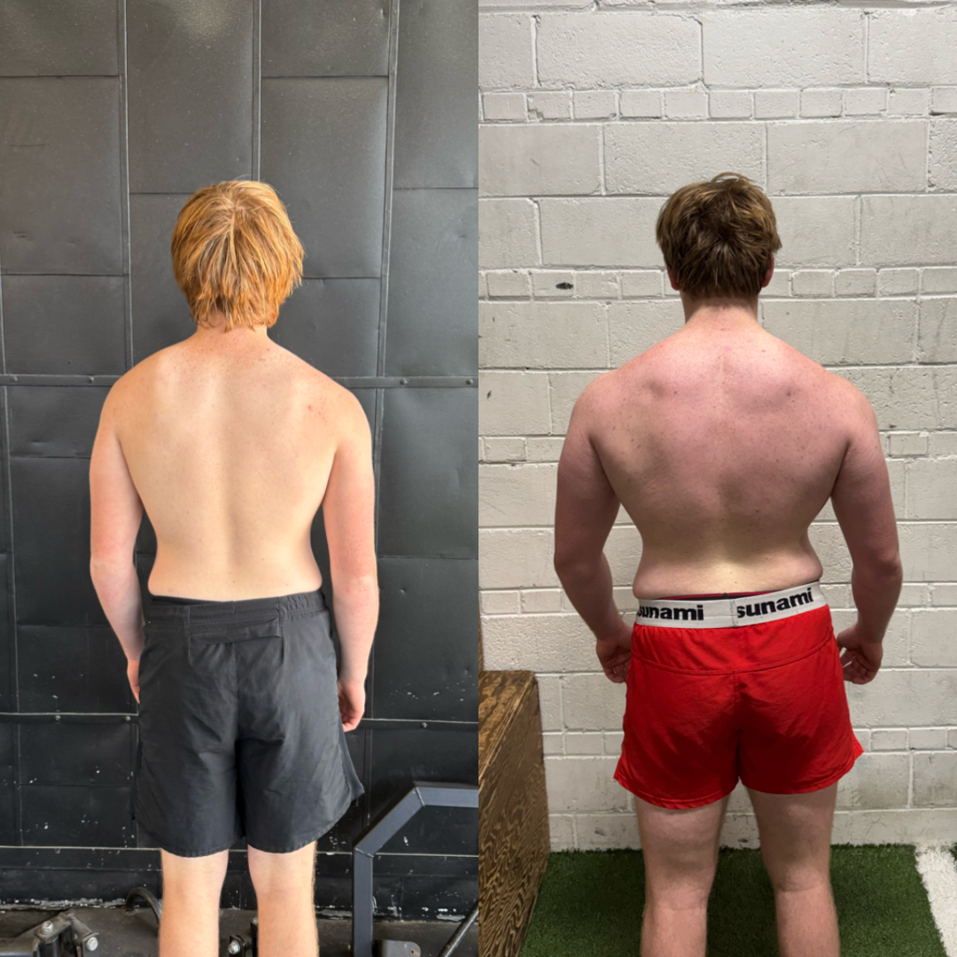 Matthew, age 17 — back view before and after 12-month SMPerformance transformation